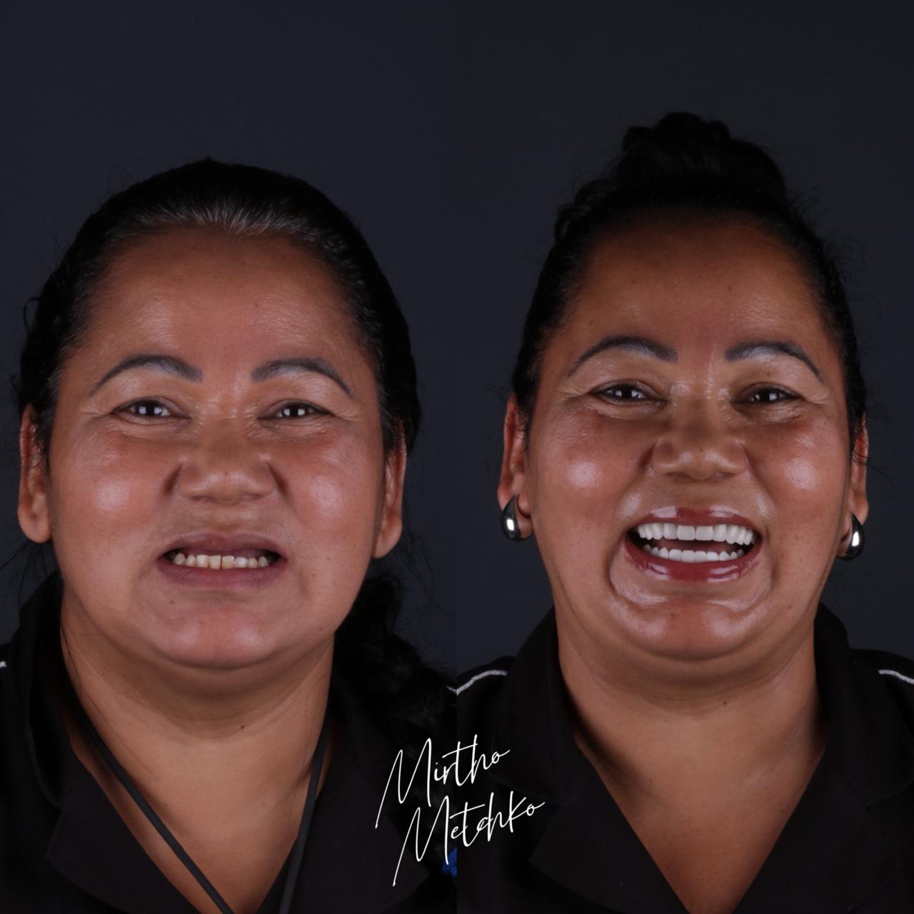 Caso de sucesso implantes - Antes e depois mulher