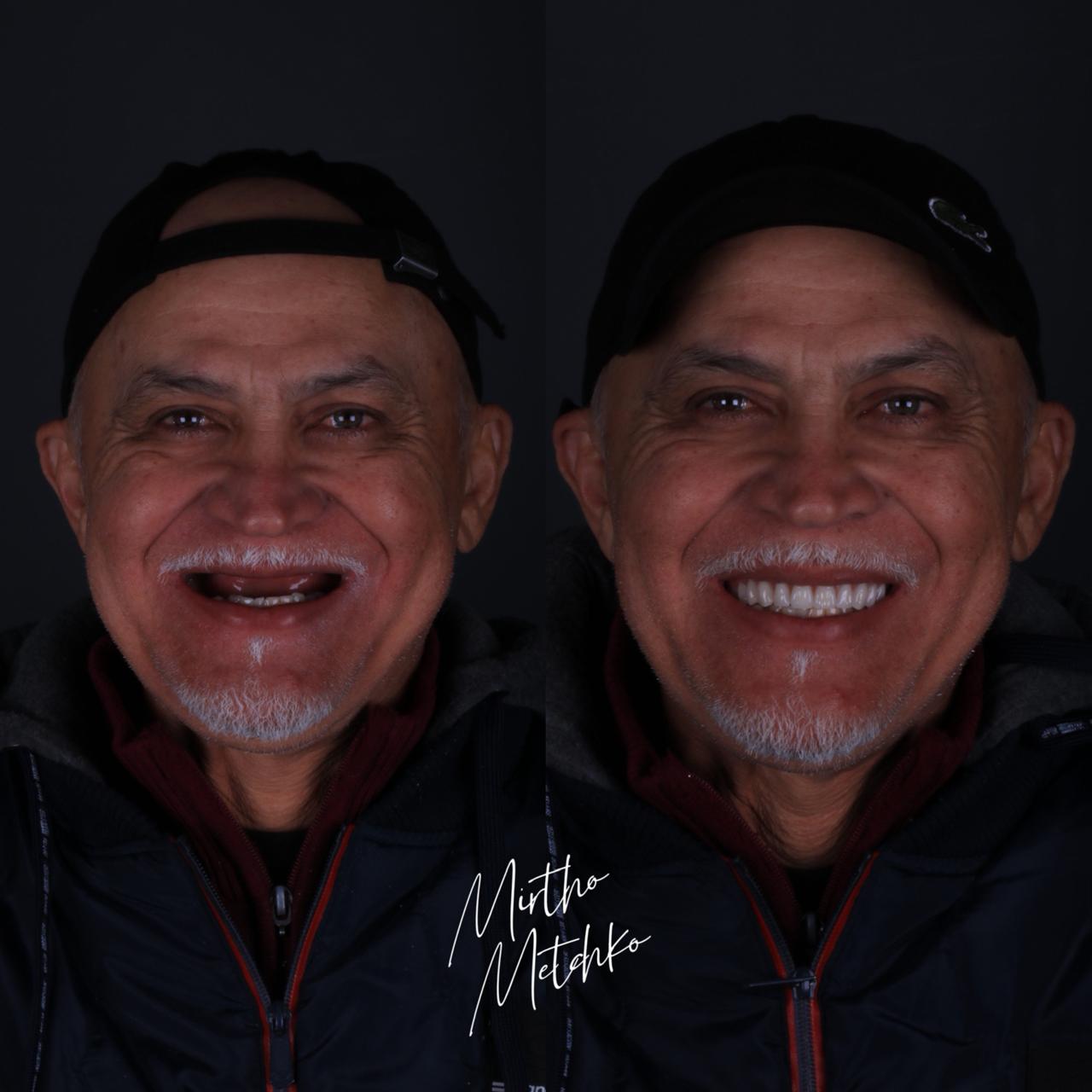 Caso de sucesso implantes - Antes e depois homem