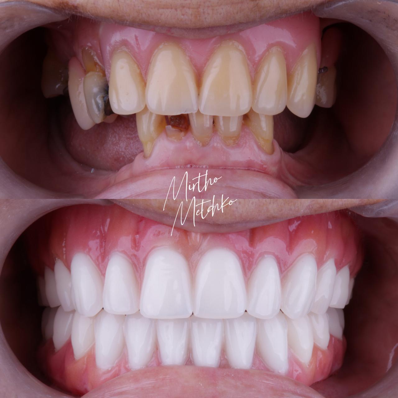 Caso de sucesso implantes - Antes e depois boca